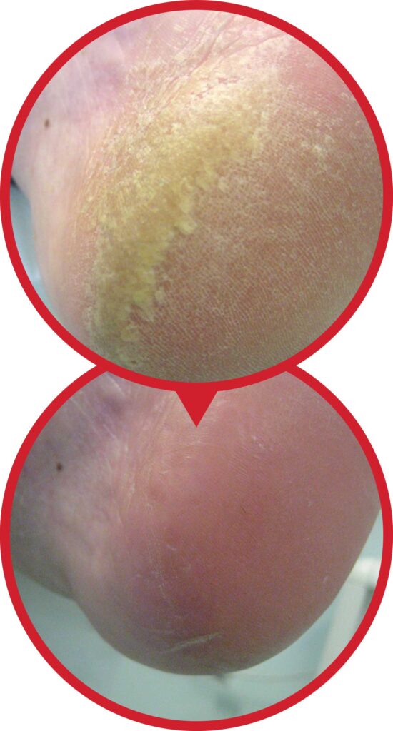 Flexitol case study left foot