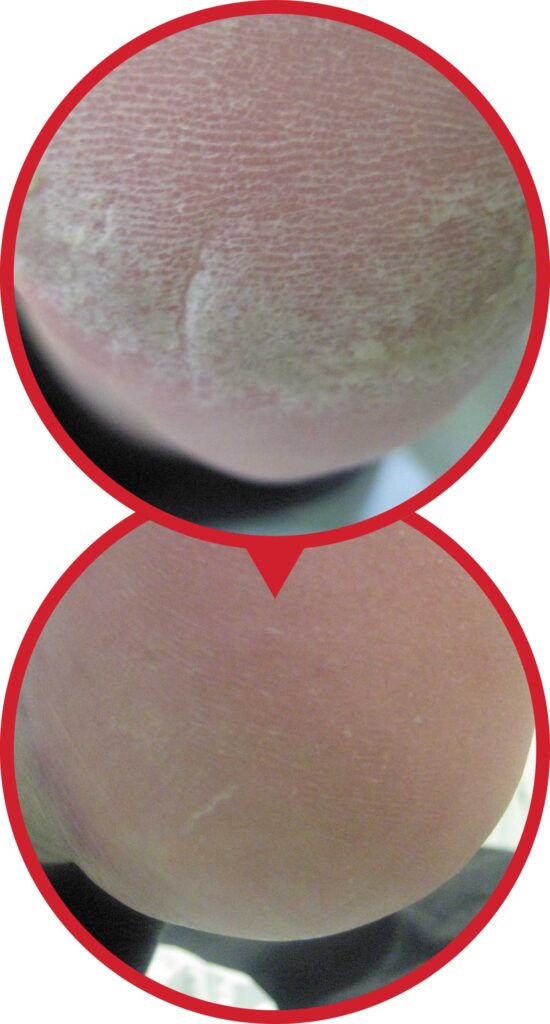 Flexitol case study right foot